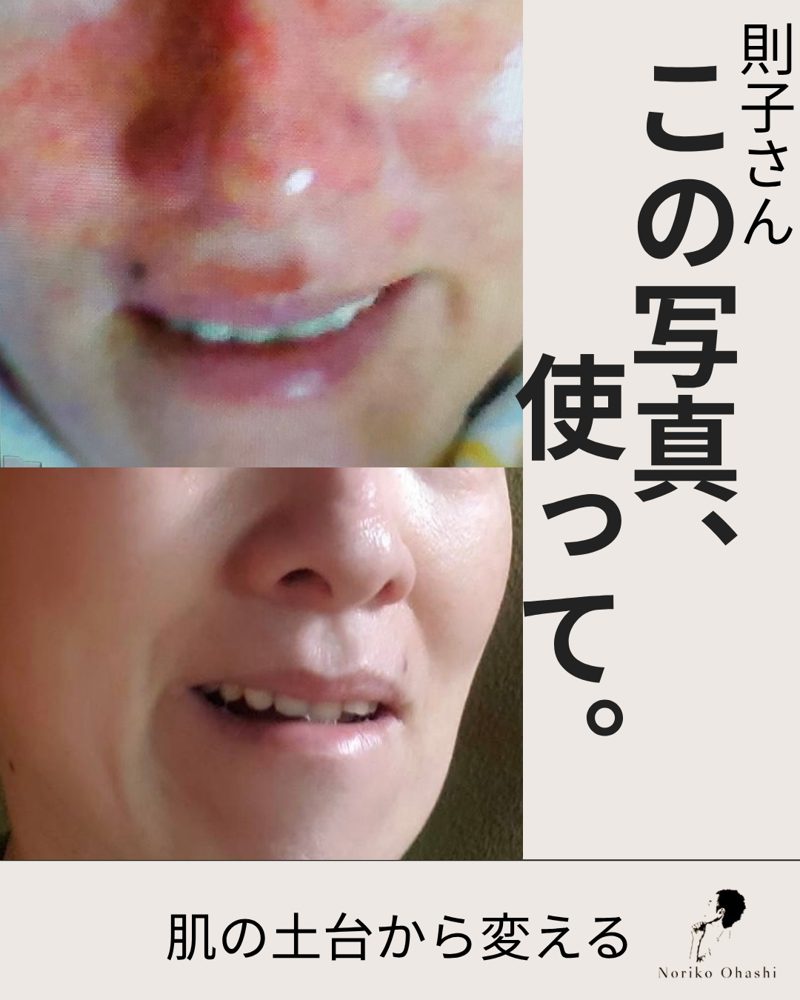 S様の肌（ご本人の許可をいただいて掲載）
